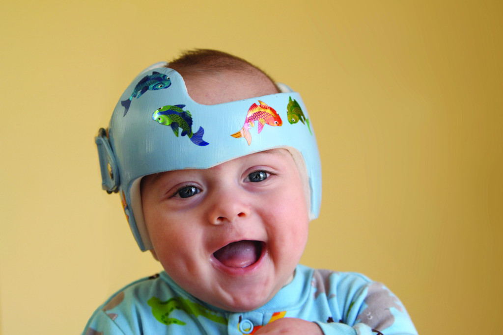 Why Do Babies Wear Helmets?